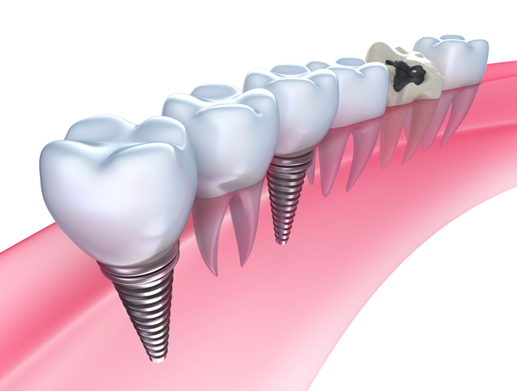 Dental Implants Your Local Dentist
